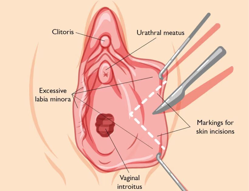 Labiaplasty Techniques